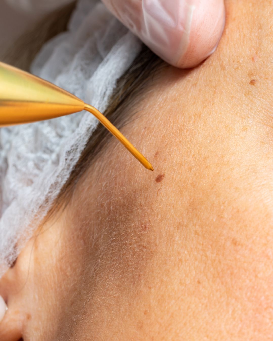 skin tag removal